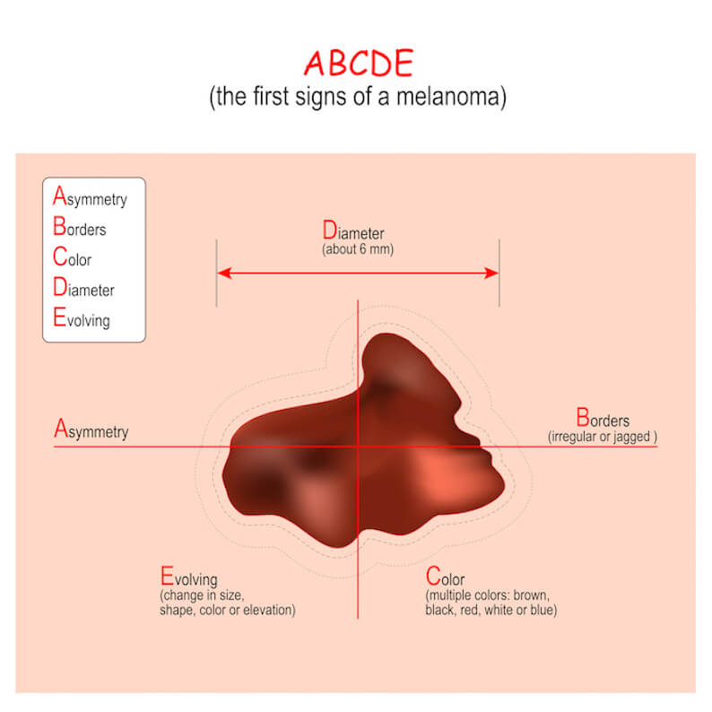 skin-cancer-101-types-diagnosis-treatment